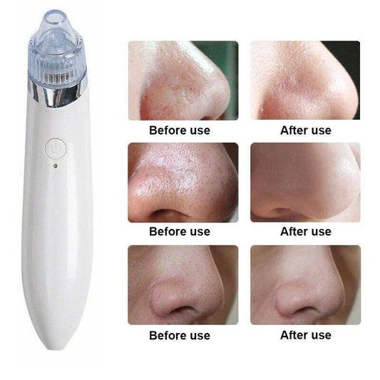 Blackhead Remover Vacuum Acne Cleaner – Deep Pore Cleansing for Flawless Skin